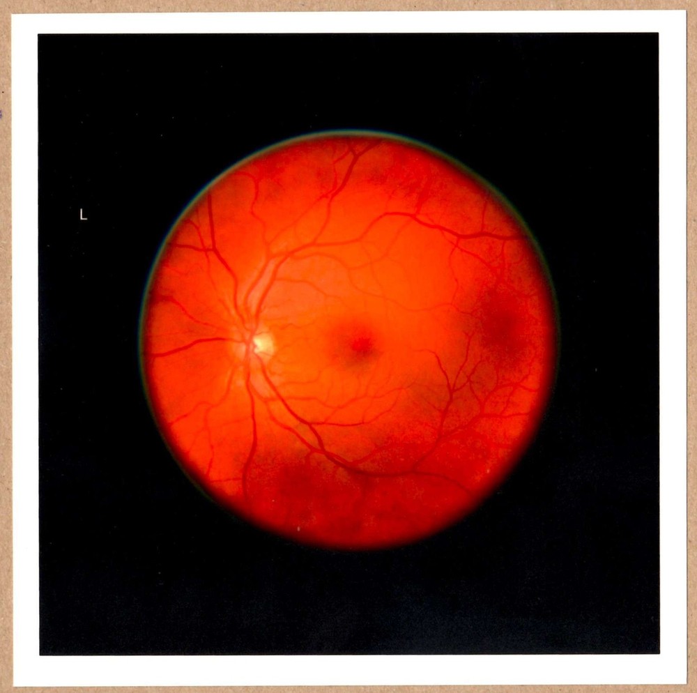 SIGNED MIKHAEL SUBOTZKY RETINAL SELF-PORTRAIT LEFT EYE LTD 6 x 6 MAGNUM PRINT